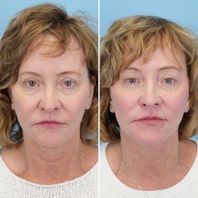 Facelift Before & After Gallery - Patient 248325 - Image 1