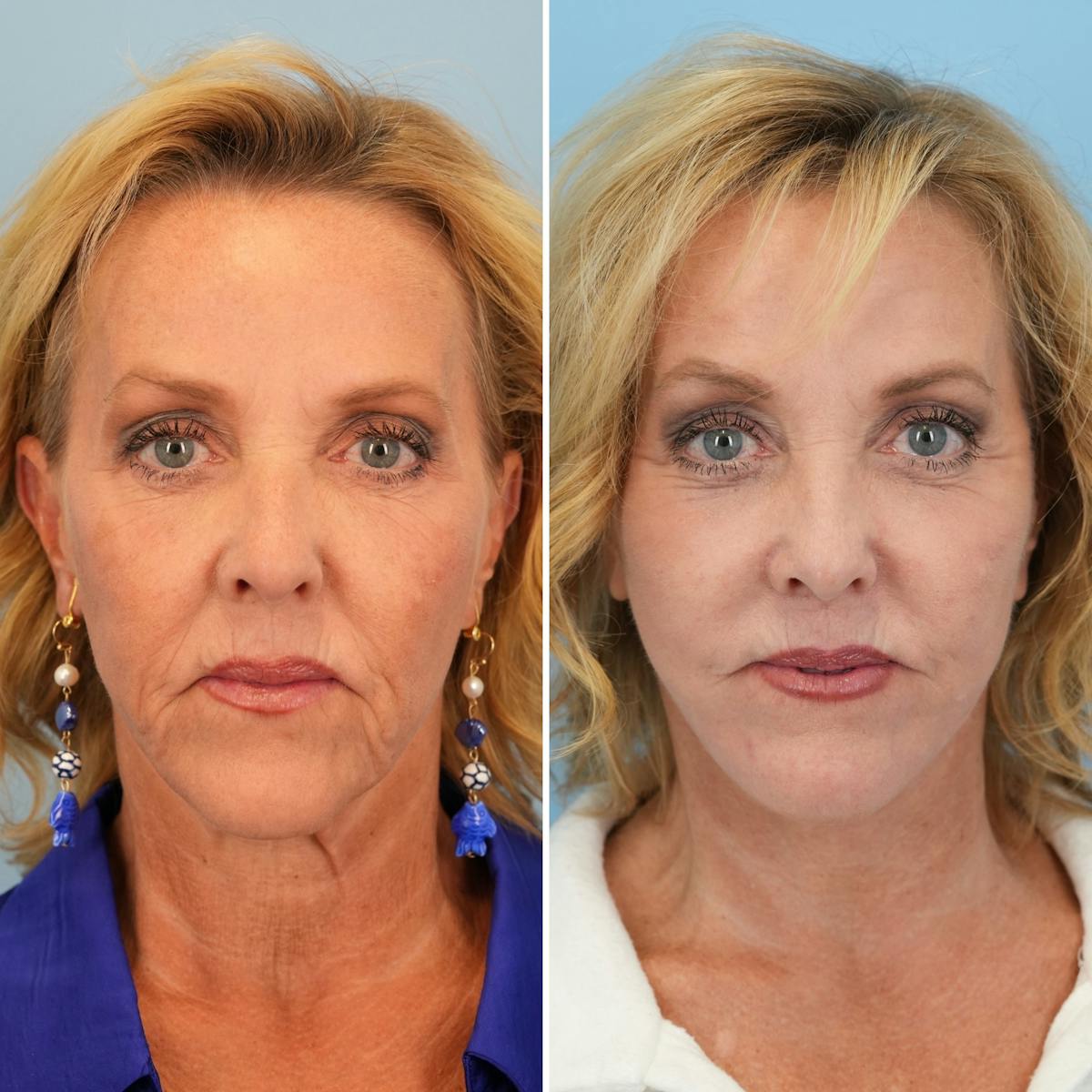 Facelift Before & After Gallery - Patient 163191 - Image 1
