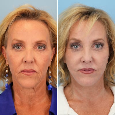 Facelift Before & After Gallery - Patient 163191 - Image 1