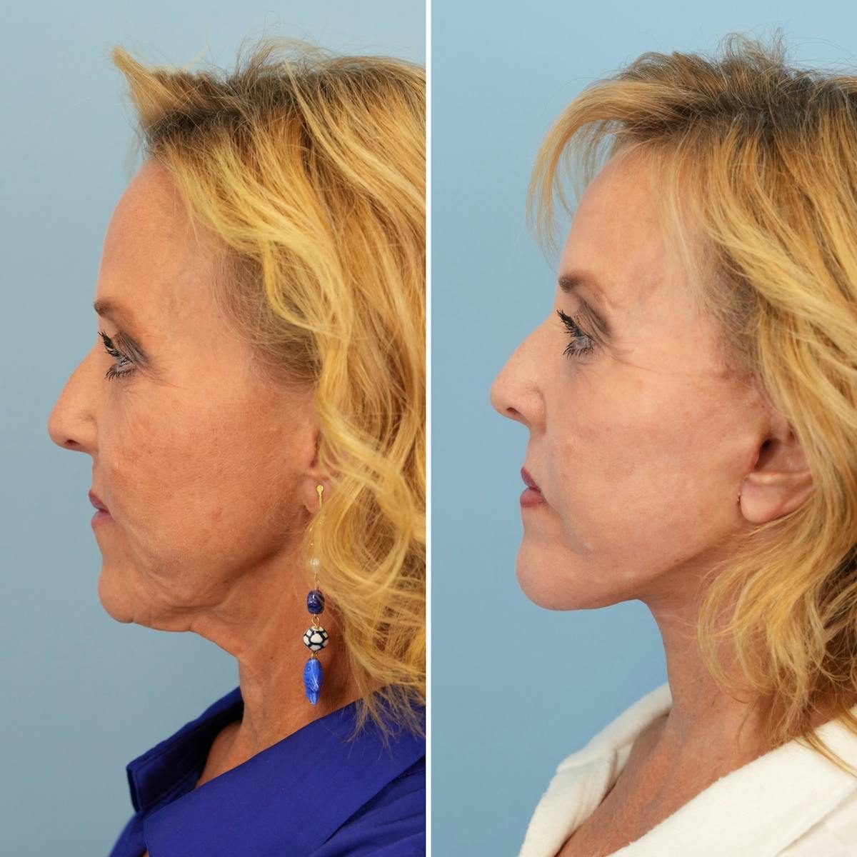 Facelift Before & After Gallery - Patient 163191 - Image 5