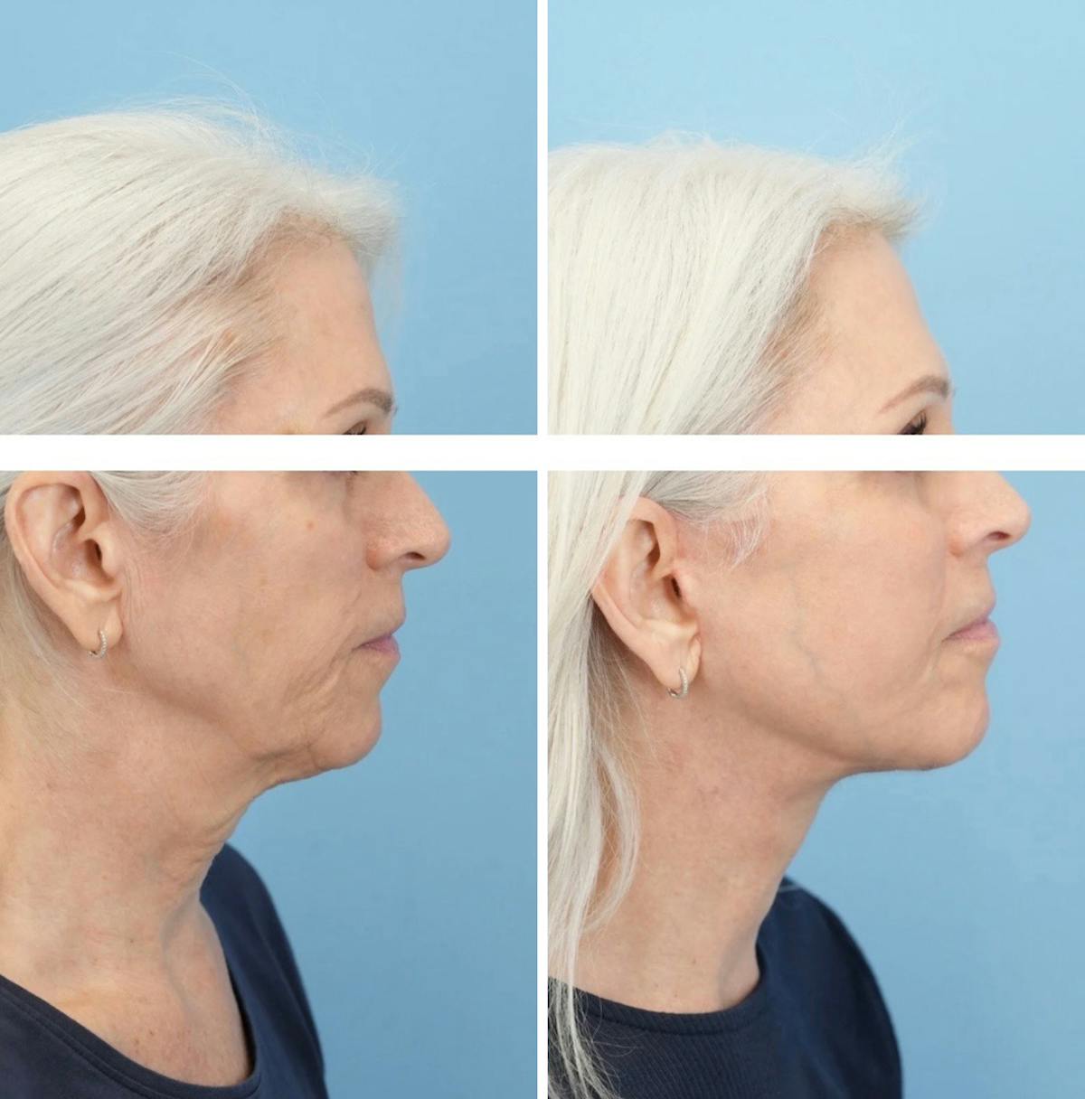Facelift Before & After Gallery - Patient 282691 - Image 3