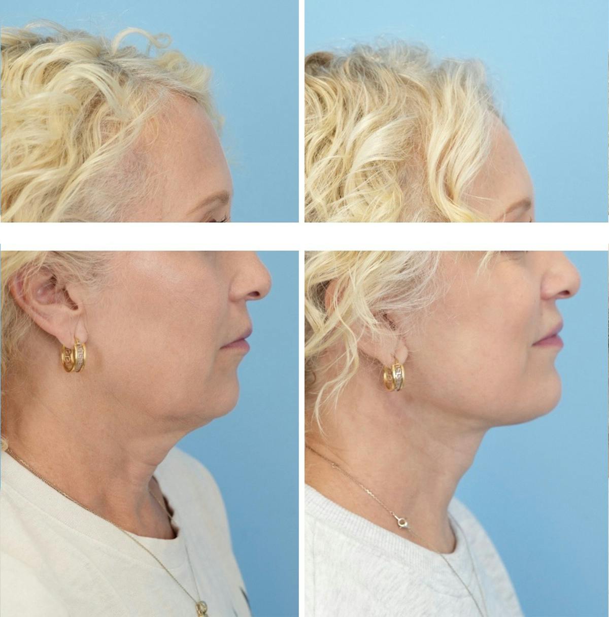 Facelift Before & After Gallery - Patient 270214 - Image 3