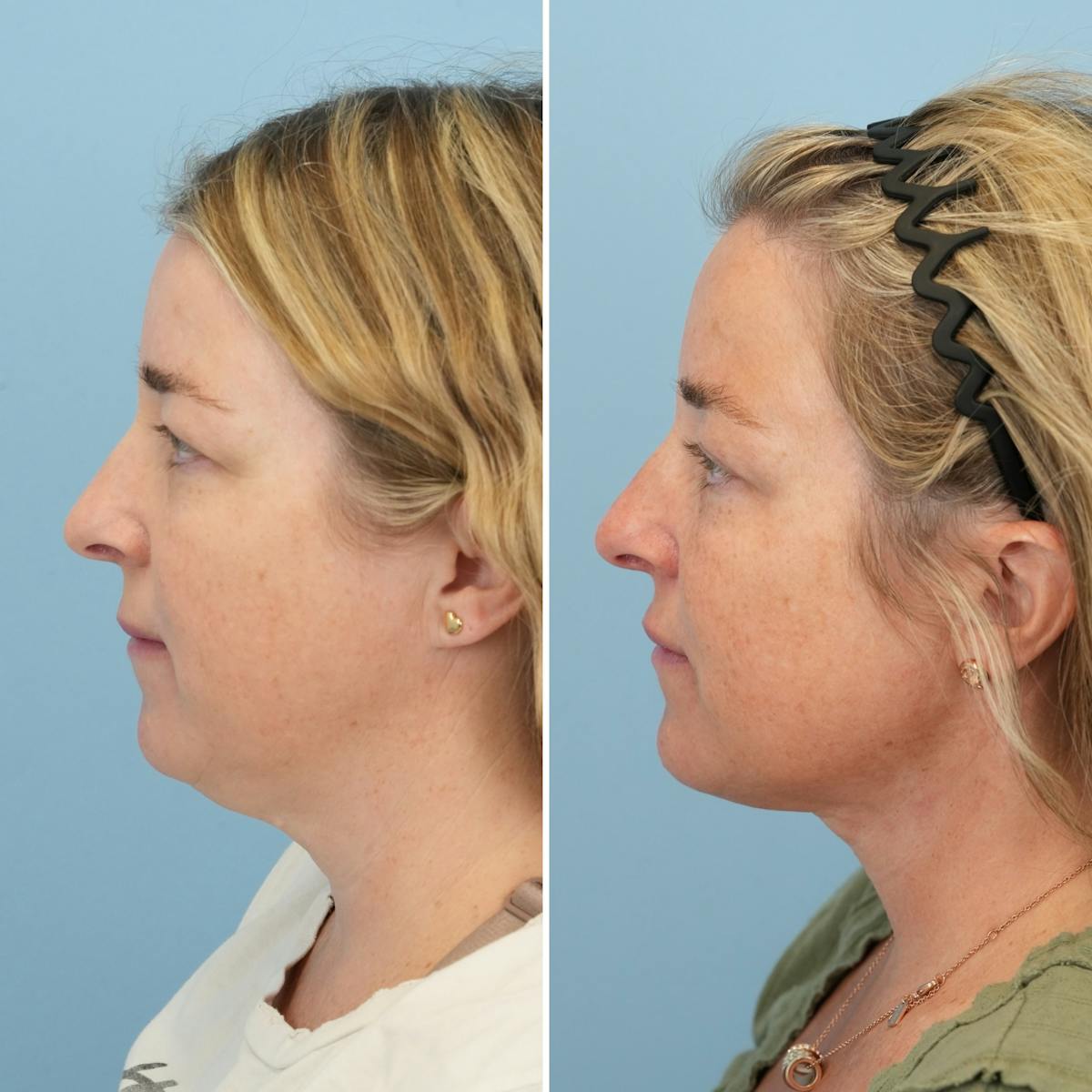 Facelift Before & After Gallery - Patient 320855 - Image 5