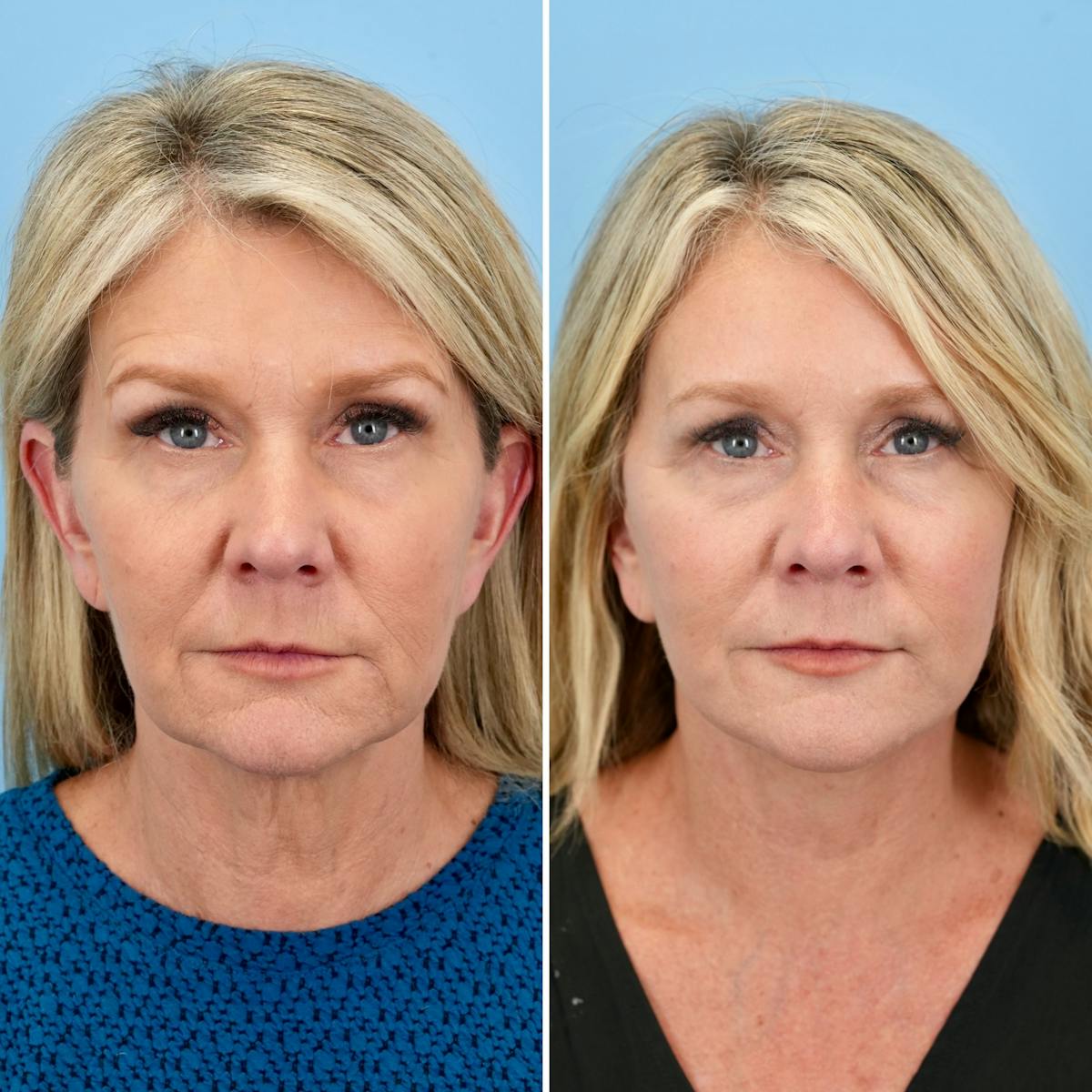 Facelift Before & After Gallery - Patient 325885 - Image 1
