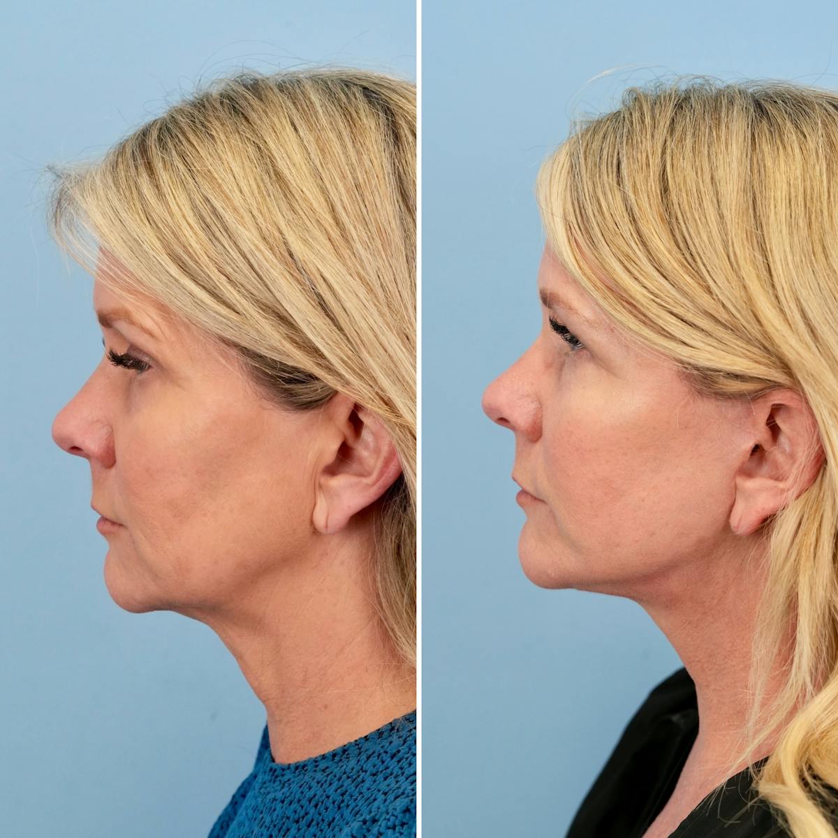 Facelift Before & After Gallery - Patient 325885 - Image 5