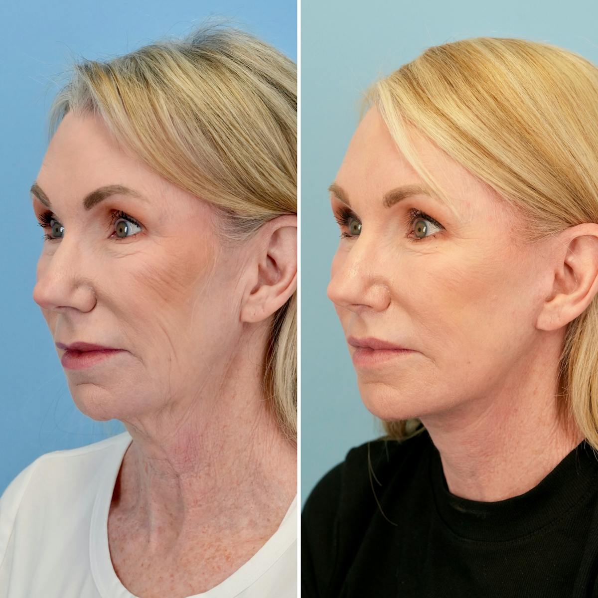 Lip Lift Before & After Gallery - Patient 731190 - Image 4
