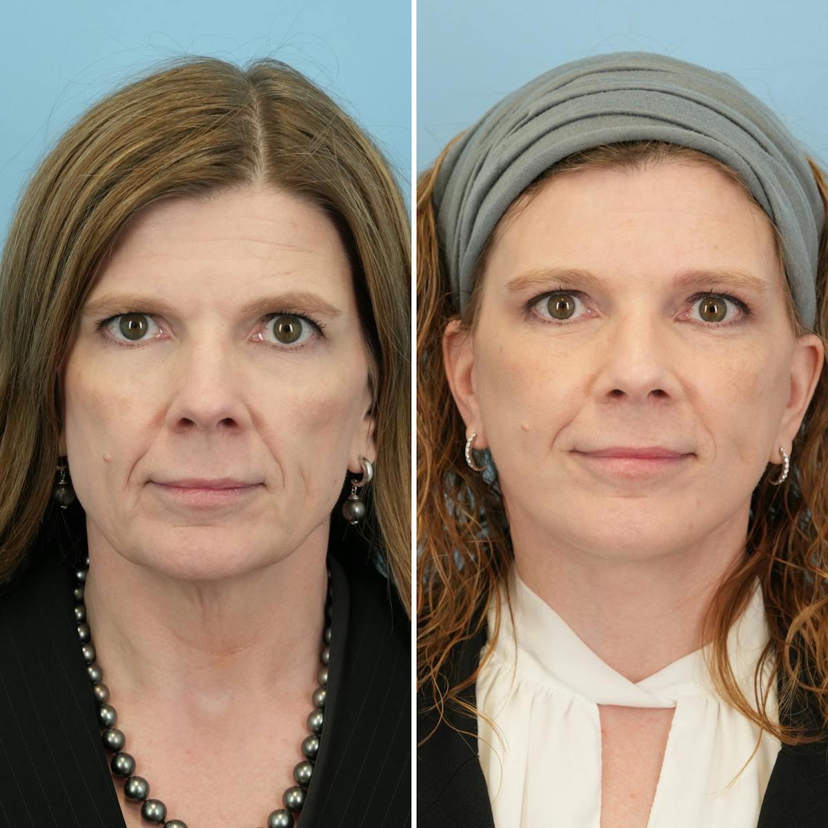 Facelift Before & After Gallery - Patient 184919 - Image 1
