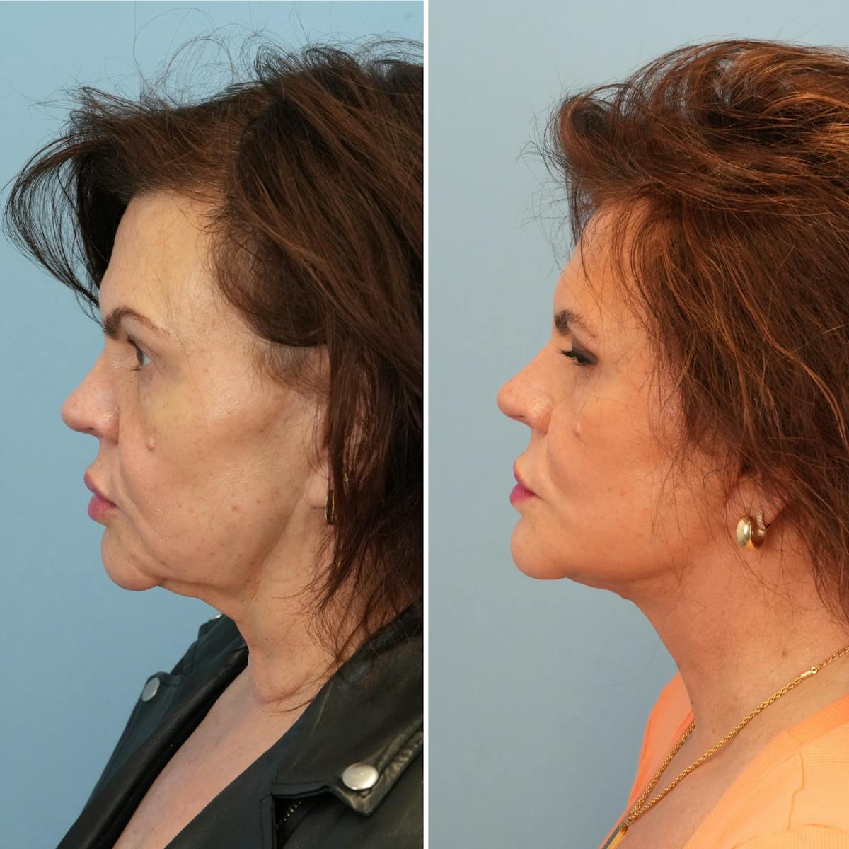 Facelift Before & After Gallery - Patient 328666 - Image 5