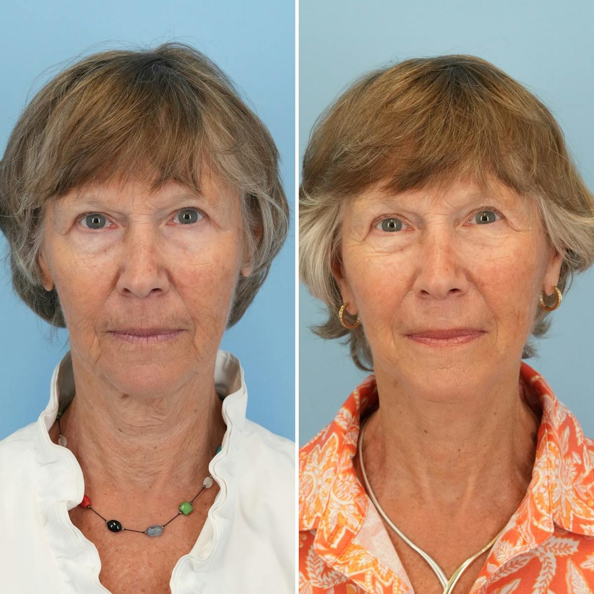 Facelift Before & After Gallery - Patient 374328 - Image 1