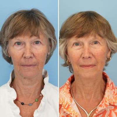 Facelift Before & After Gallery - Patient 374328 - Image 1