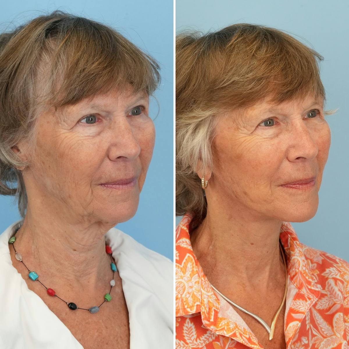 Facelift Before & After Gallery - Patient 374328 - Image 2