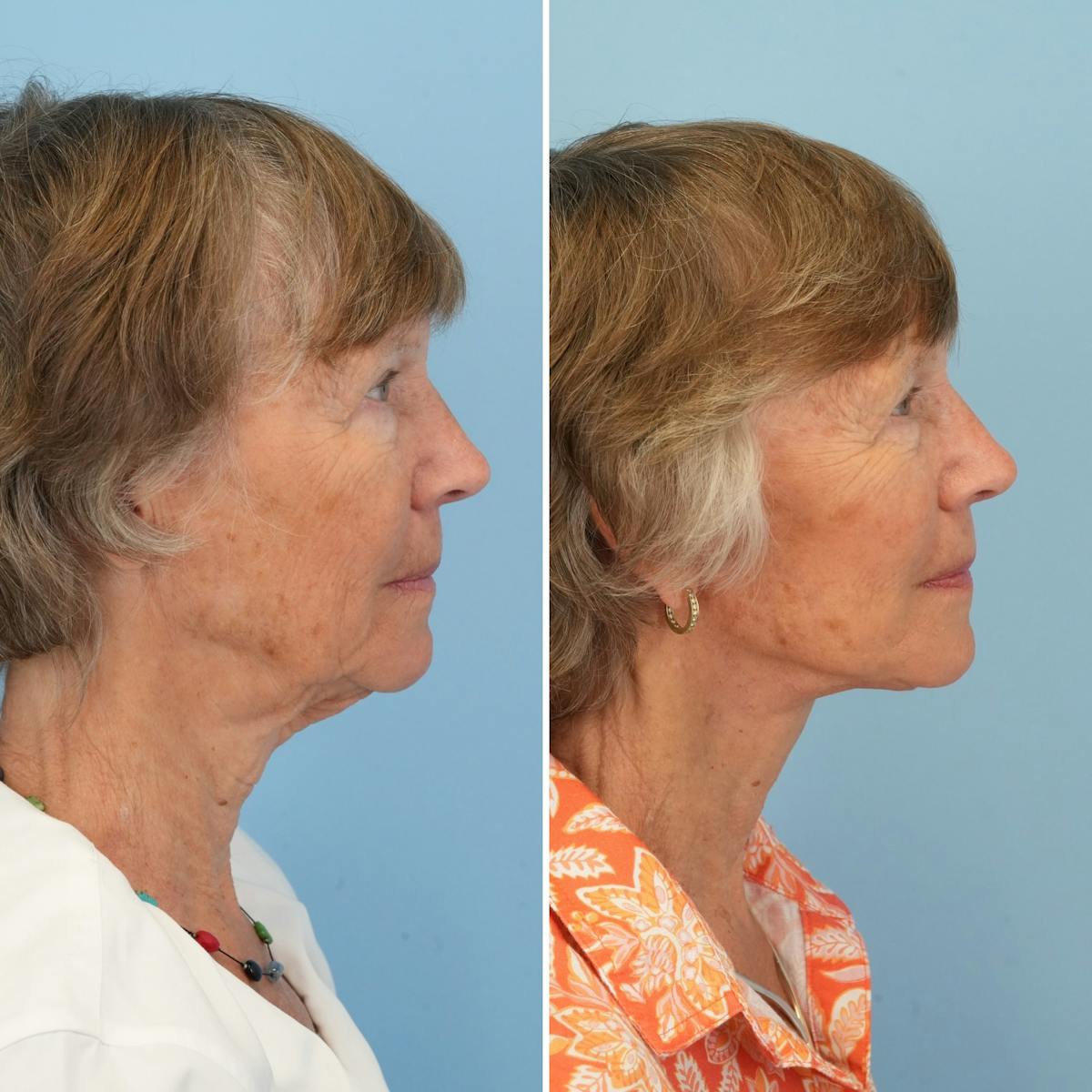 Facelift Before & After Gallery - Patient 374328 - Image 3