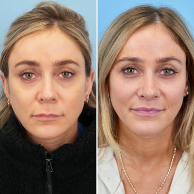 Lip Lift Before & After Gallery - Patient 207760 - Image 1