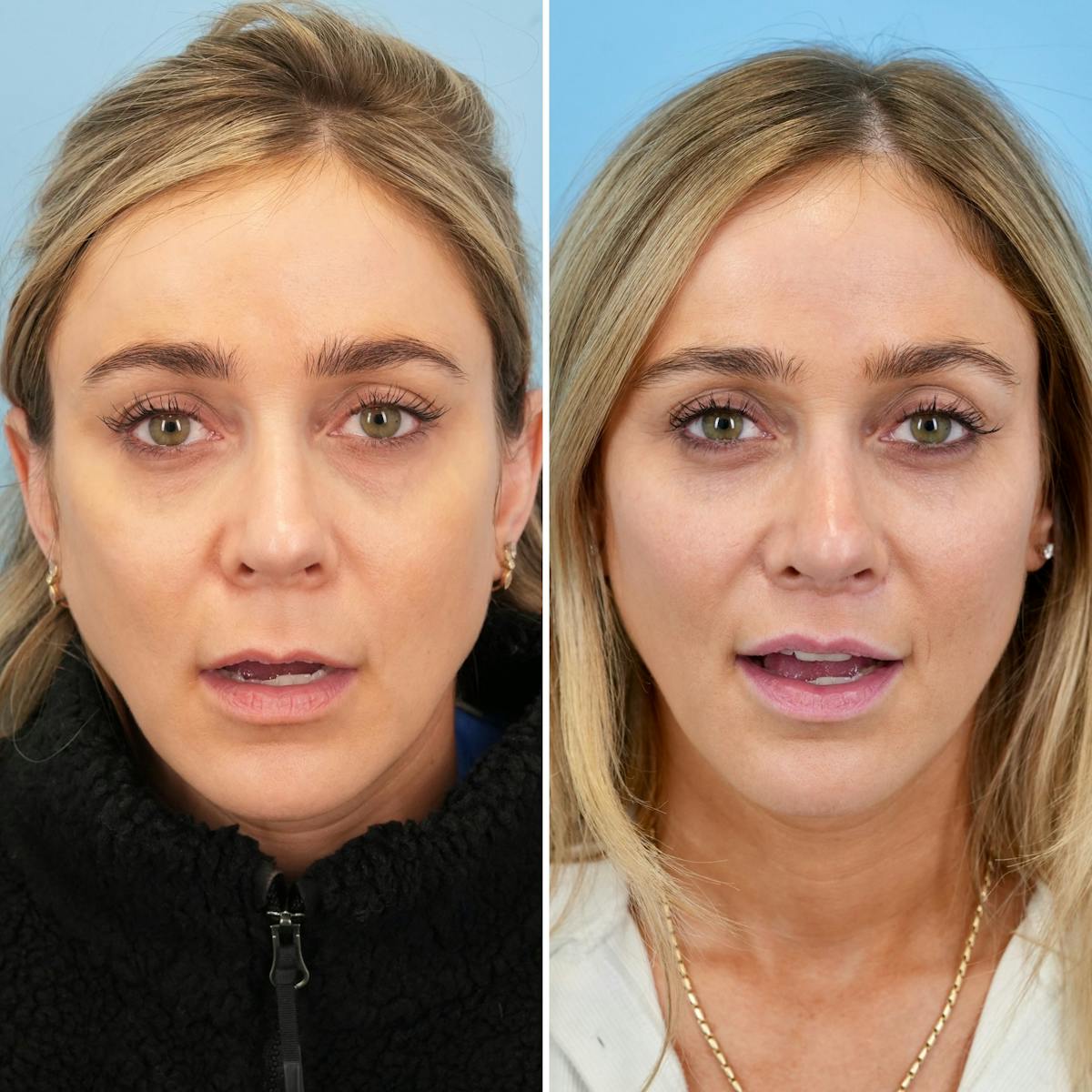 Lip Lift Before & After Gallery - Patient 207760 - Image 2