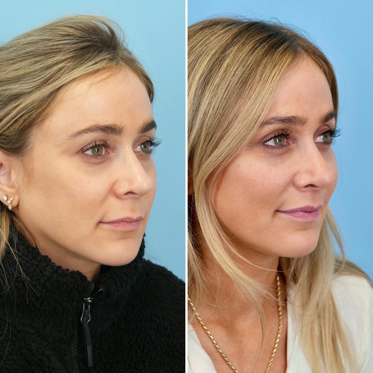 Lip Lift Before & After Gallery - Patient 207760 - Image 3