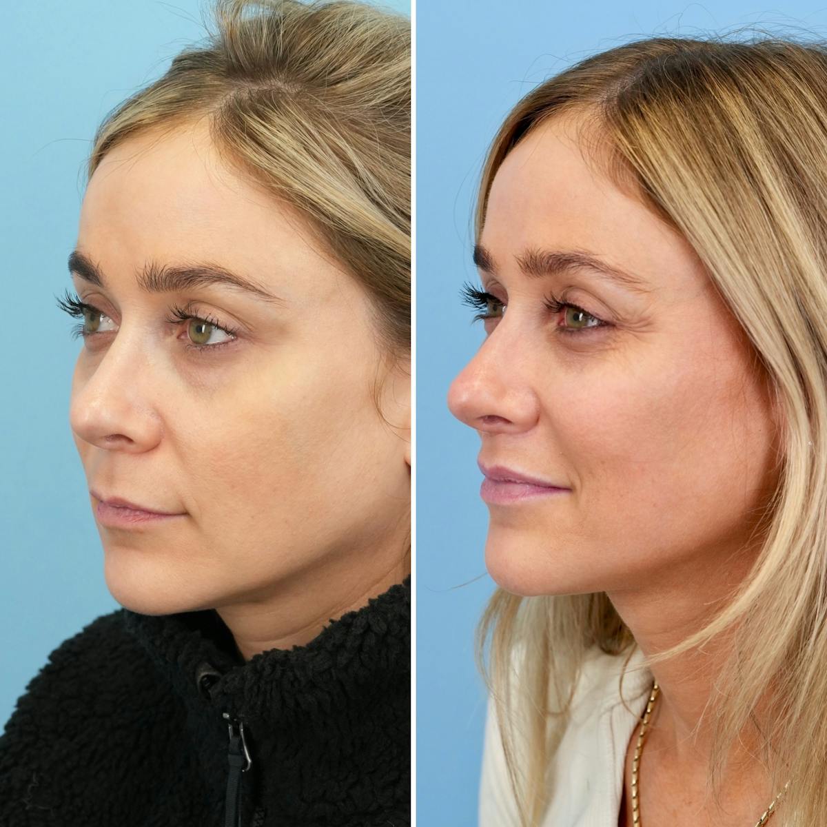 Lip Lift Before & After Gallery - Patient 207760 - Image 5