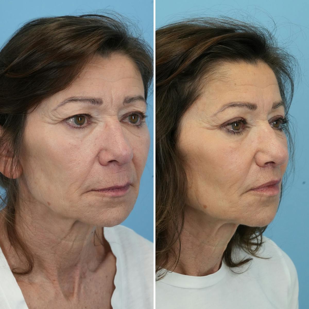 Lip Lift Before & After Gallery - Patient 368845 - Image 3