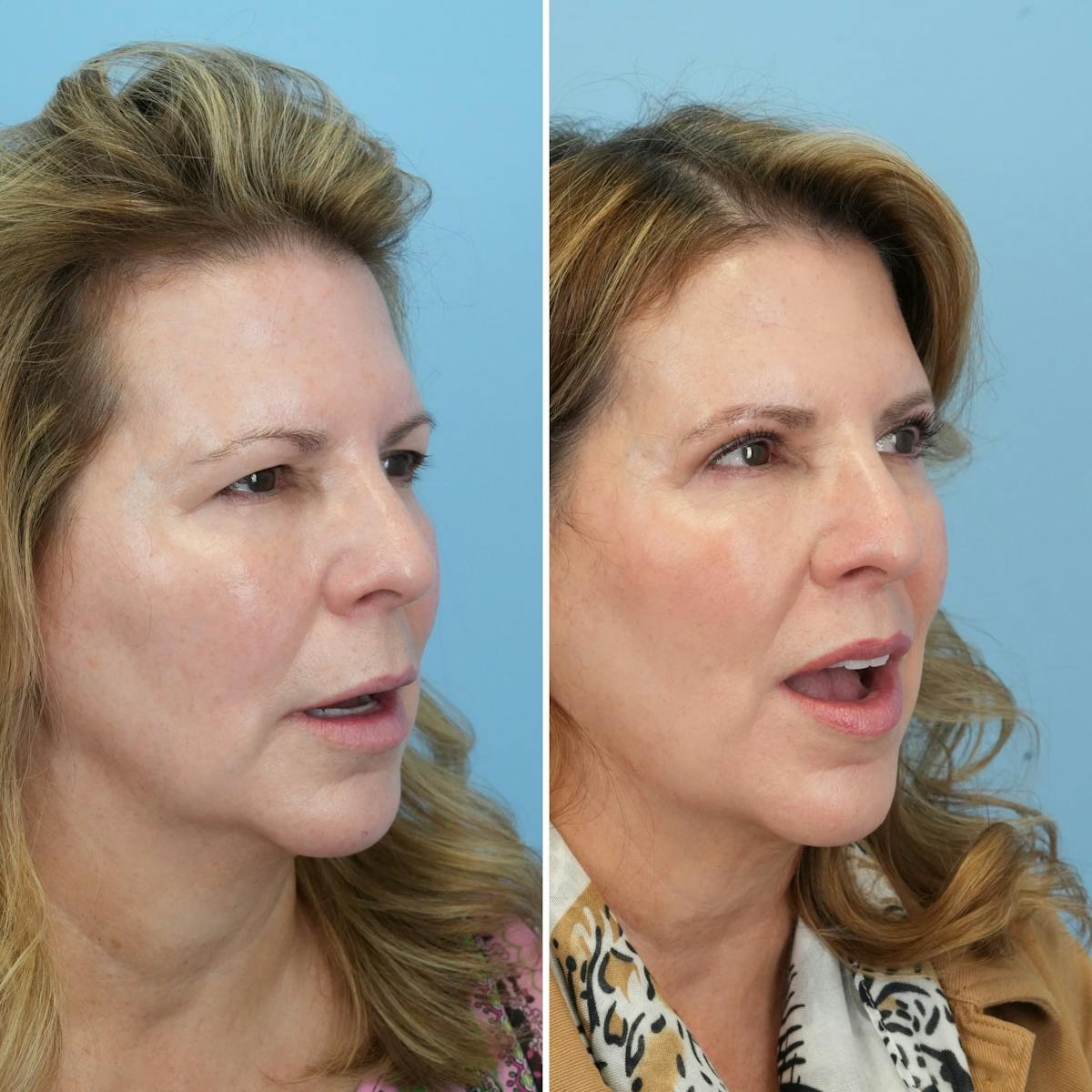 Lip Lift Before & After Gallery - Patient 286972 - Image 3