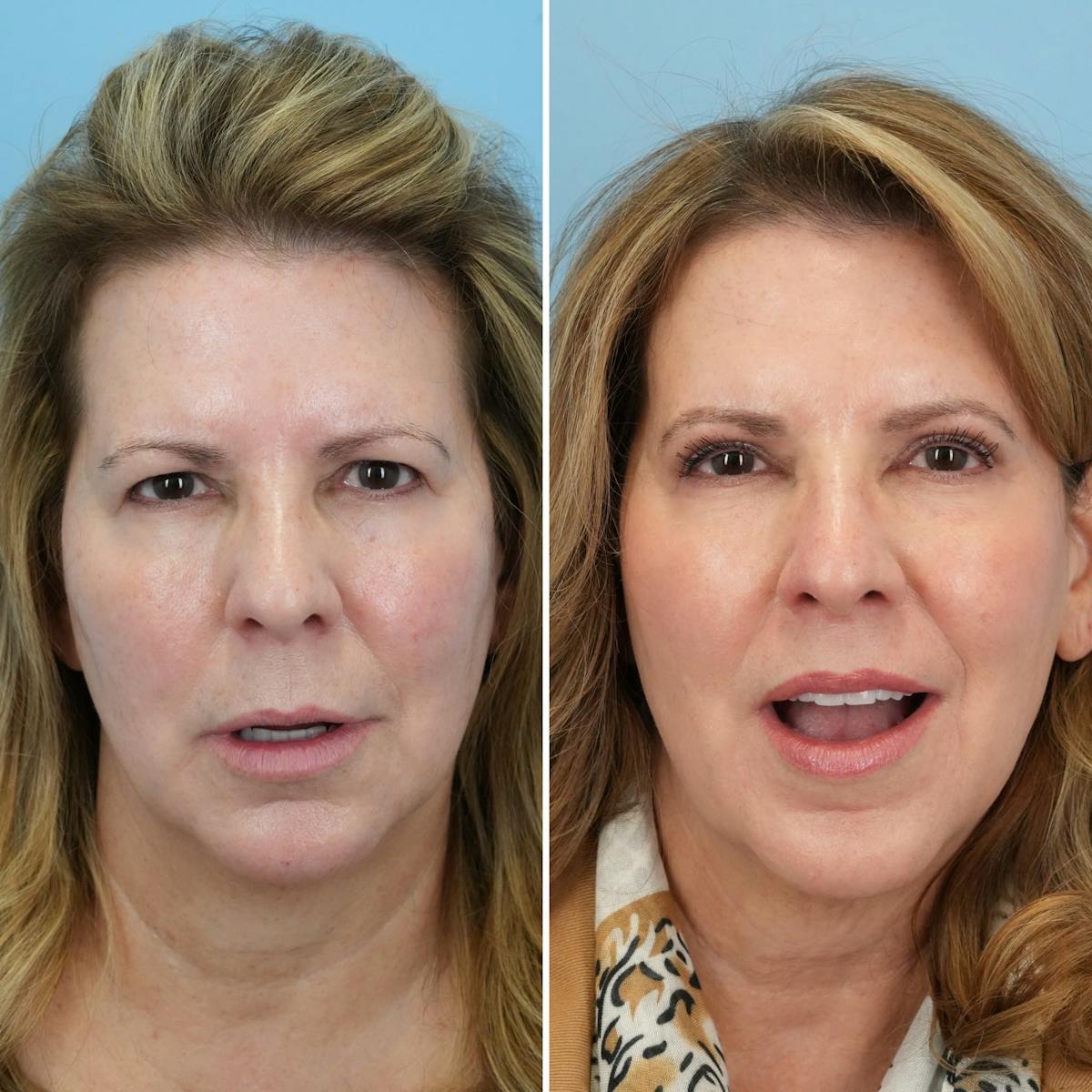Lip Lift Before & After Gallery - Patient 286972 - Image 4