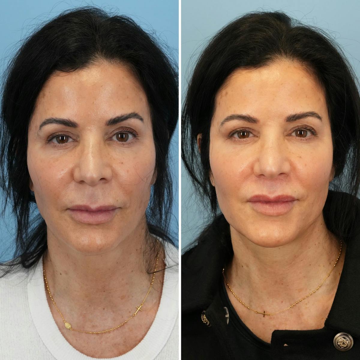 Lip Lift Before & After Gallery - Patient 286573 - Image 1