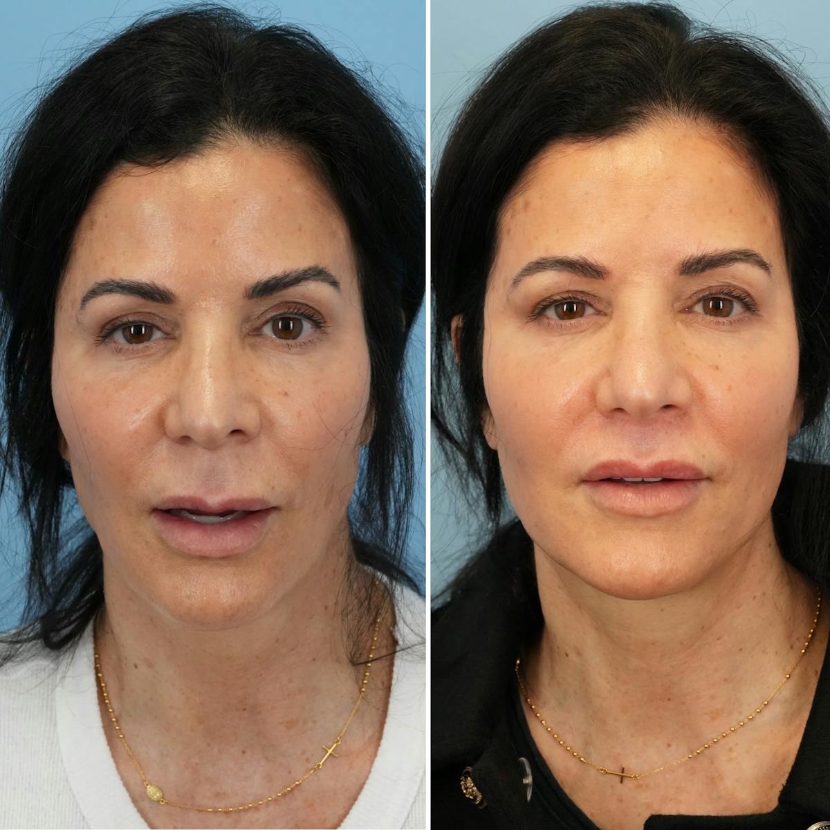 Lip Lift Before & After Gallery - Patient 286573 - Image 2