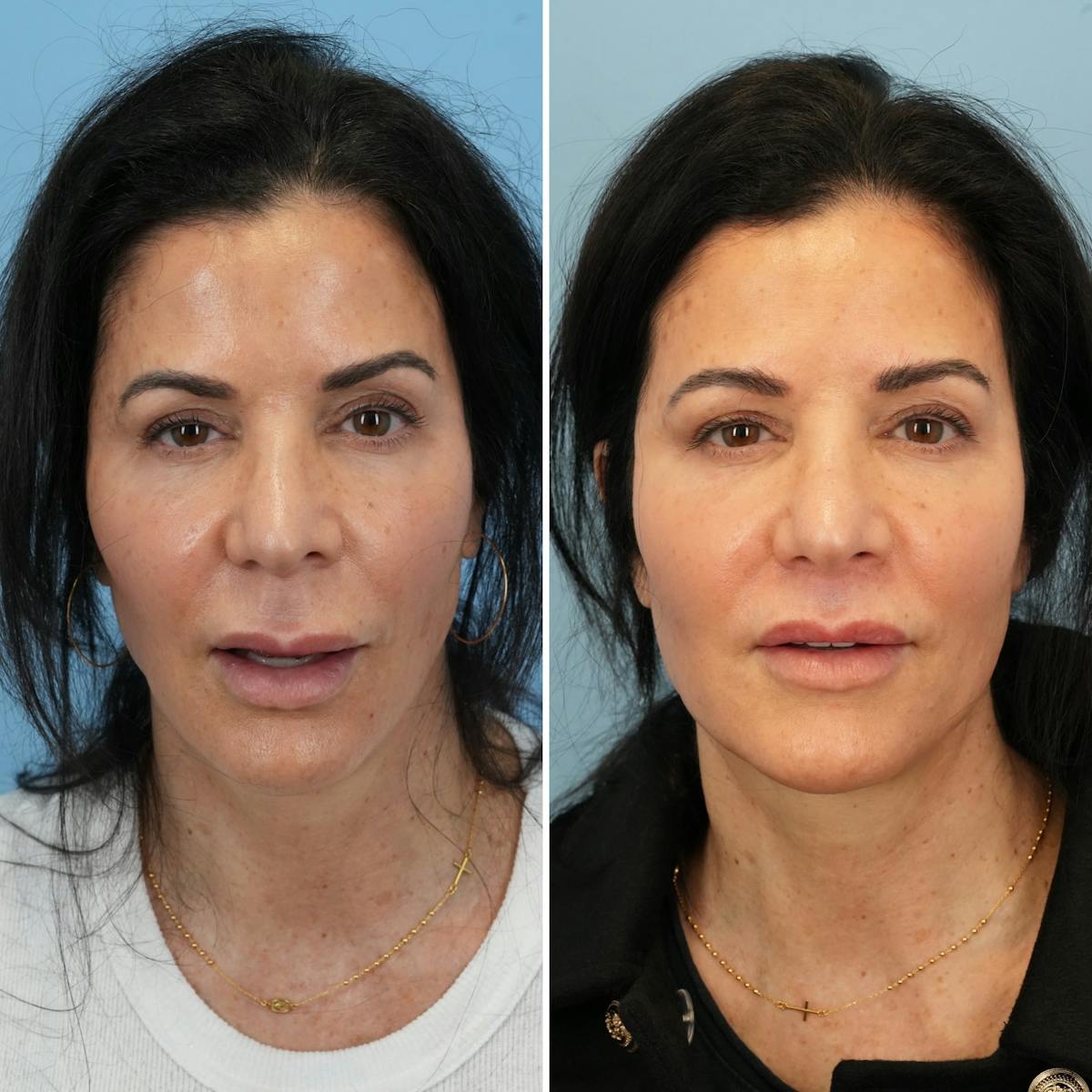 Lip Lift Before & After Gallery - Patient 286573 - Image 3