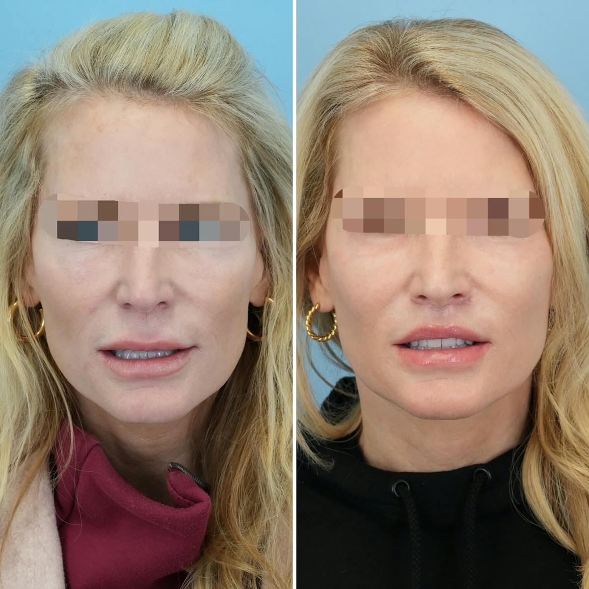 Lip Lift Before & After Gallery - Patient 449379 - Image 2