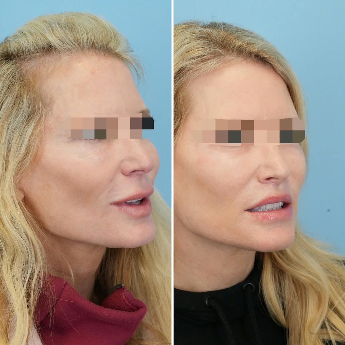 Lip Lift Before & After Gallery - Patient 449379 - Image 5