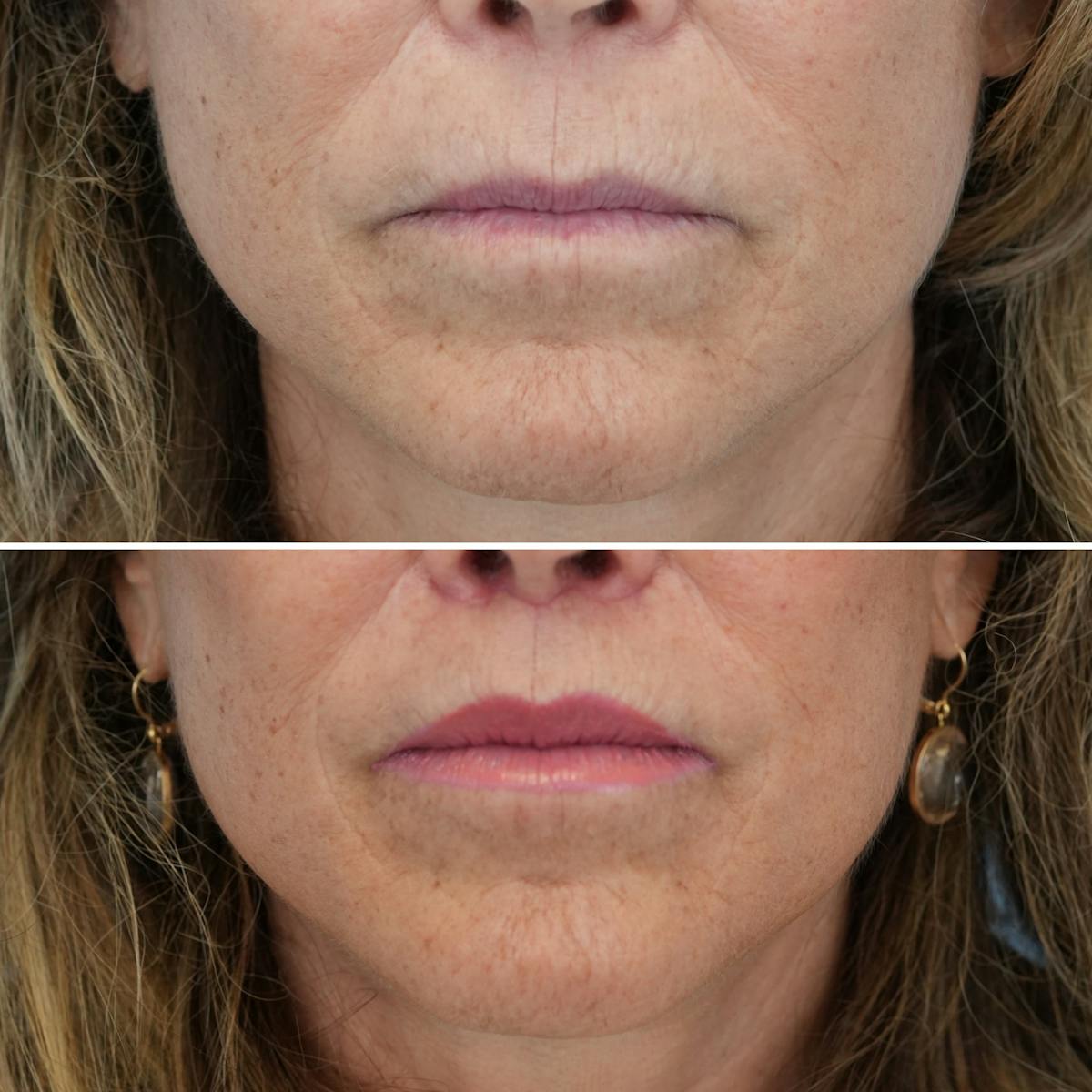 Lip Lift Before & After Gallery - Patient 397801 - Image 1