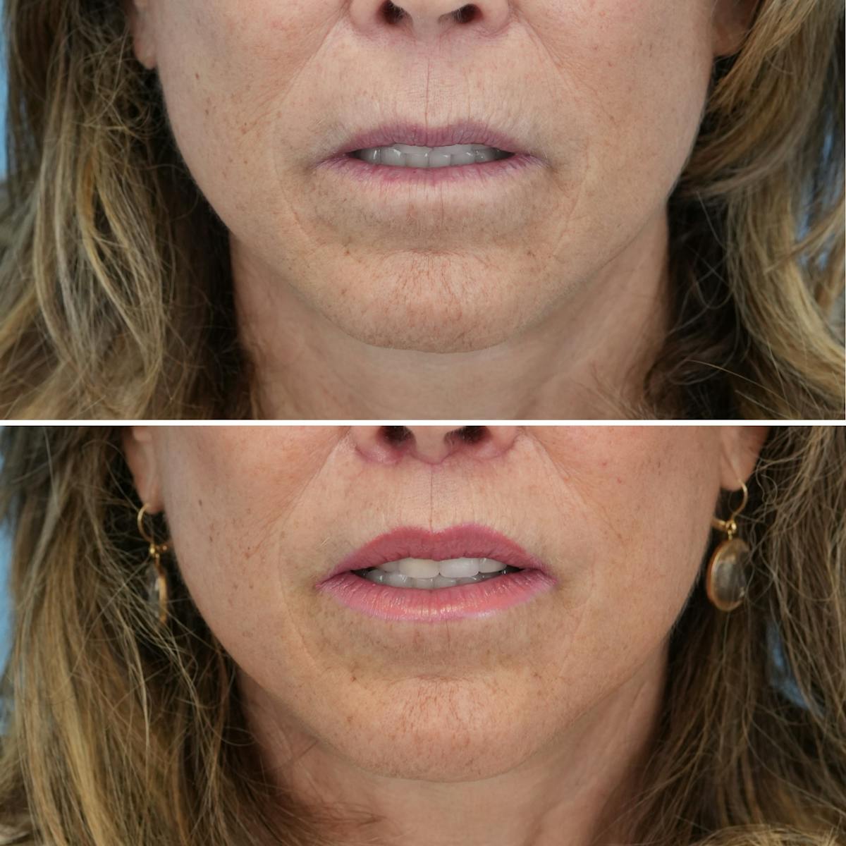 Lip Lift Before & After Gallery - Patient 397801 - Image 2