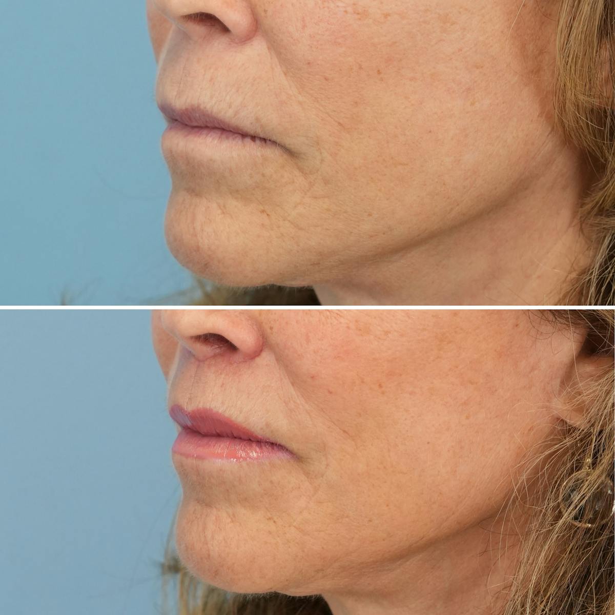 Lip Lift Before & After Gallery - Patient 397801 - Image 3