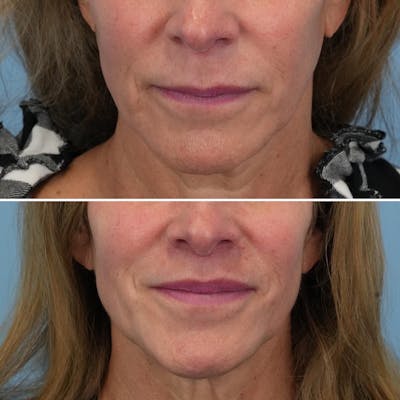 Lip Lift Before & After Gallery - Patient 314055 - Image 1