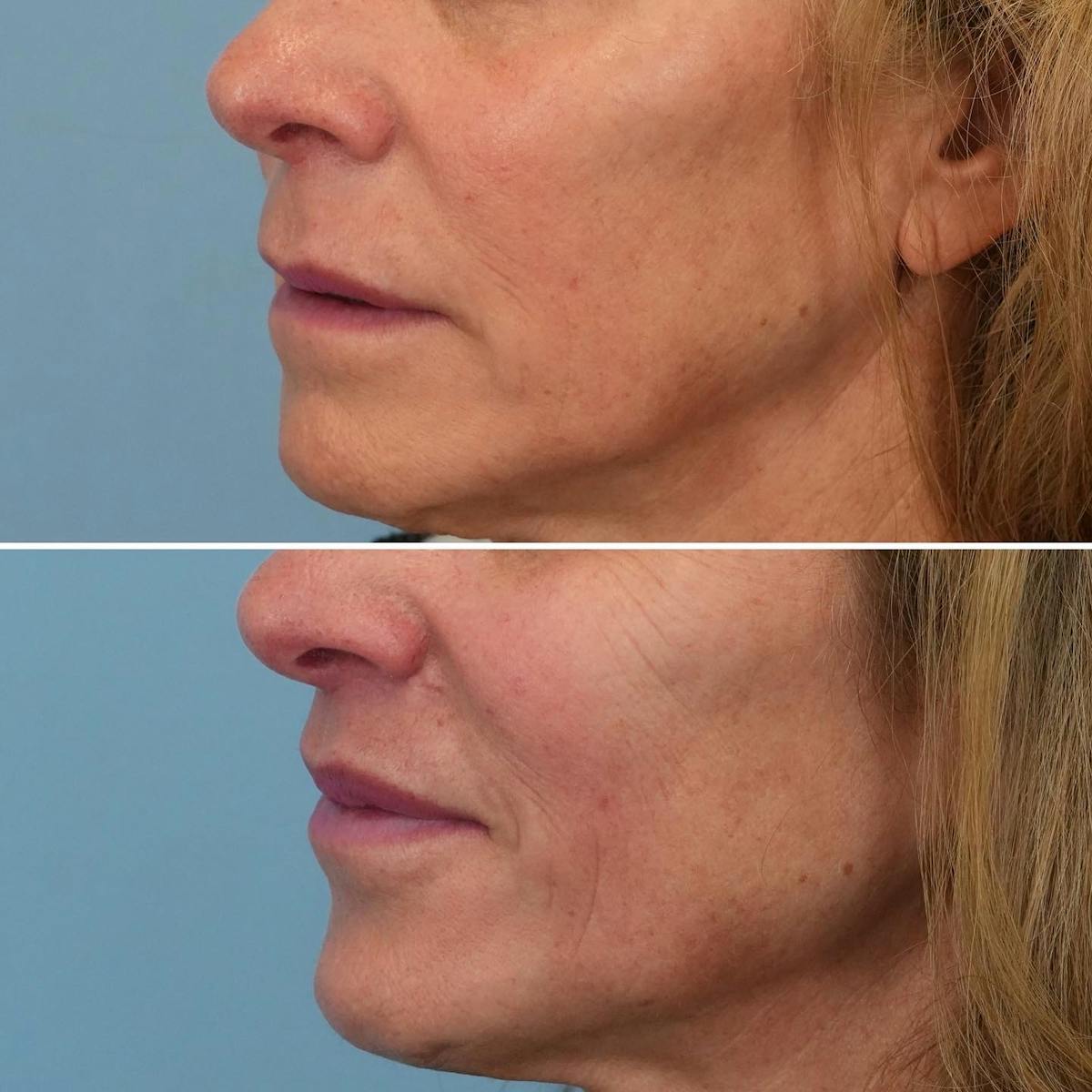 Lip Lift Before & After Gallery - Patient 314055 - Image 2