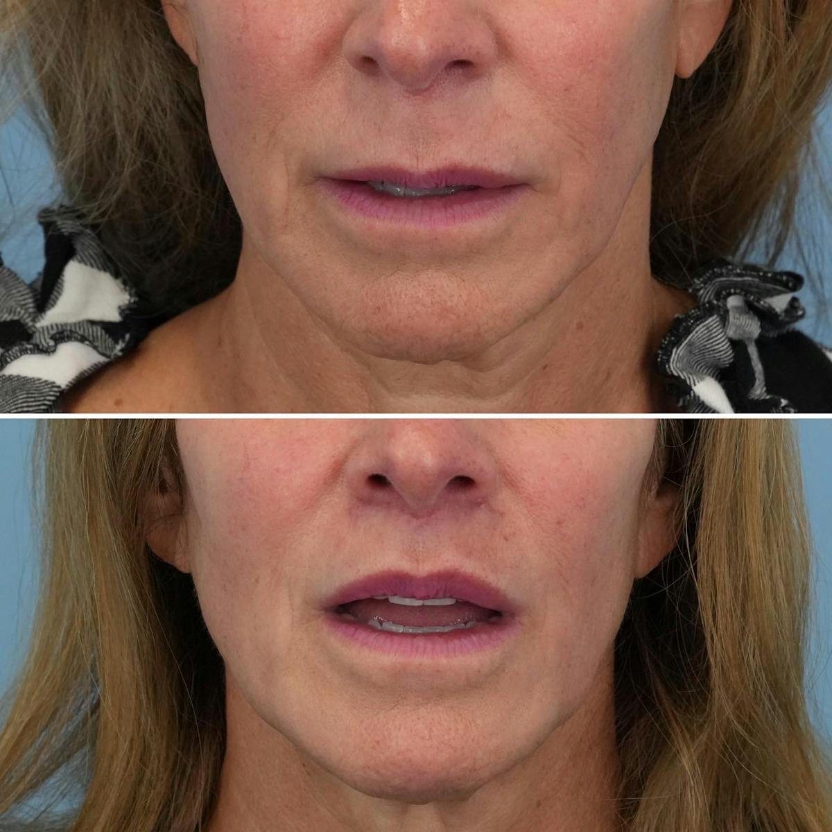 Lip Lift Before & After Gallery - Patient 314055 - Image 3