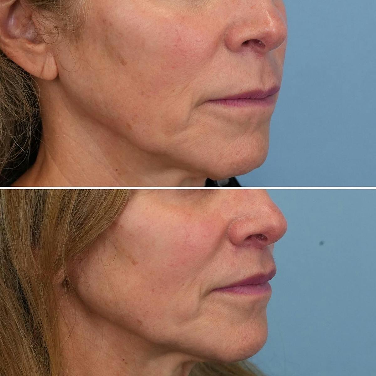 Lip Lift Before & After Gallery - Patient 314055 - Image 4