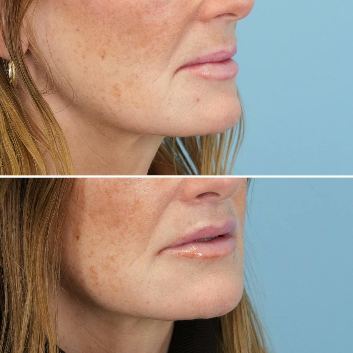 Lip Lift Before & After Gallery - Patient 231261 - Image 5