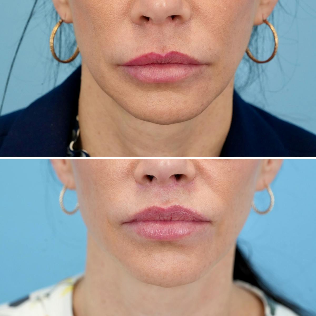Lip Lift Before & After Gallery - Patient 410047 - Image 1
