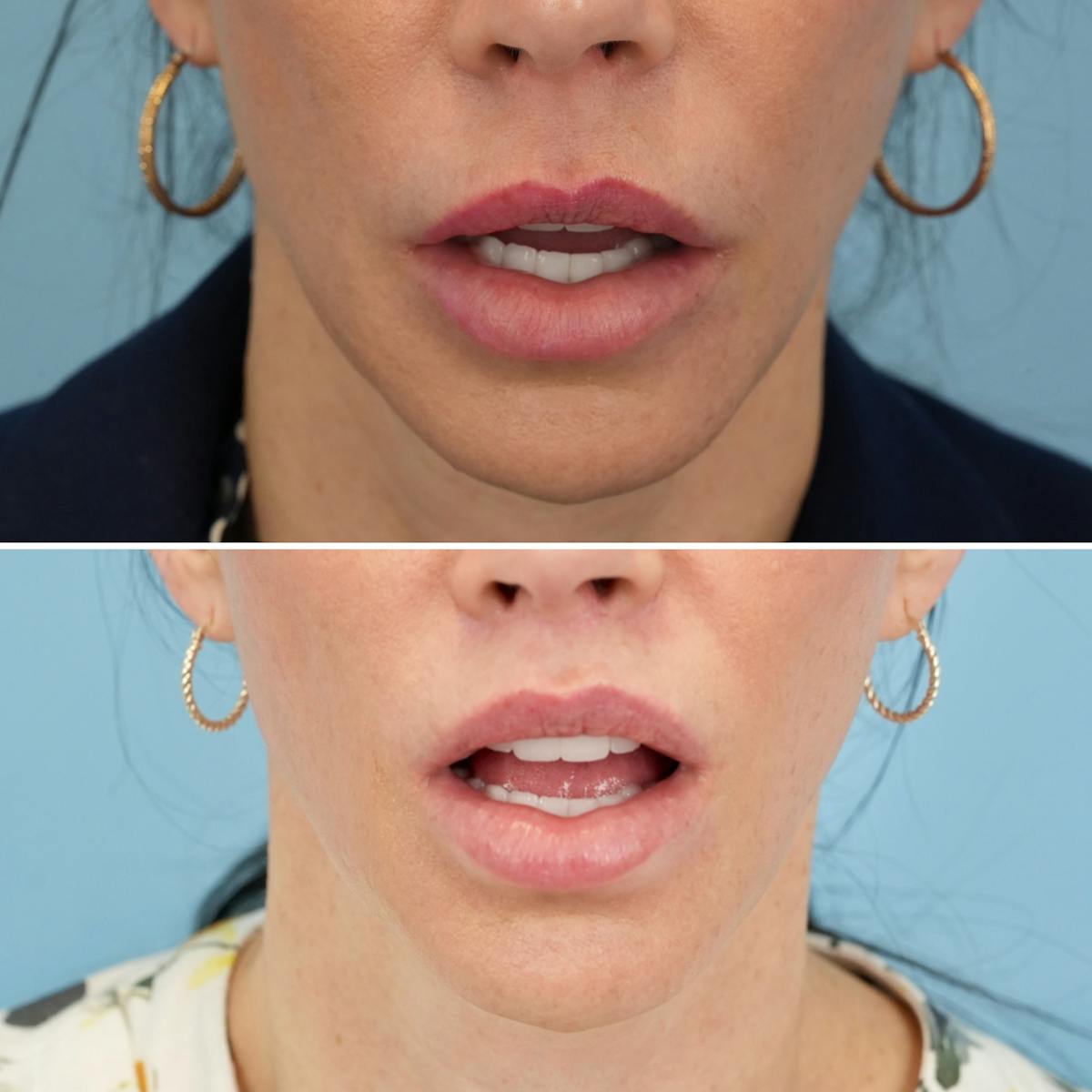 Lip Lift Before & After Gallery - Patient 410047 - Image 2