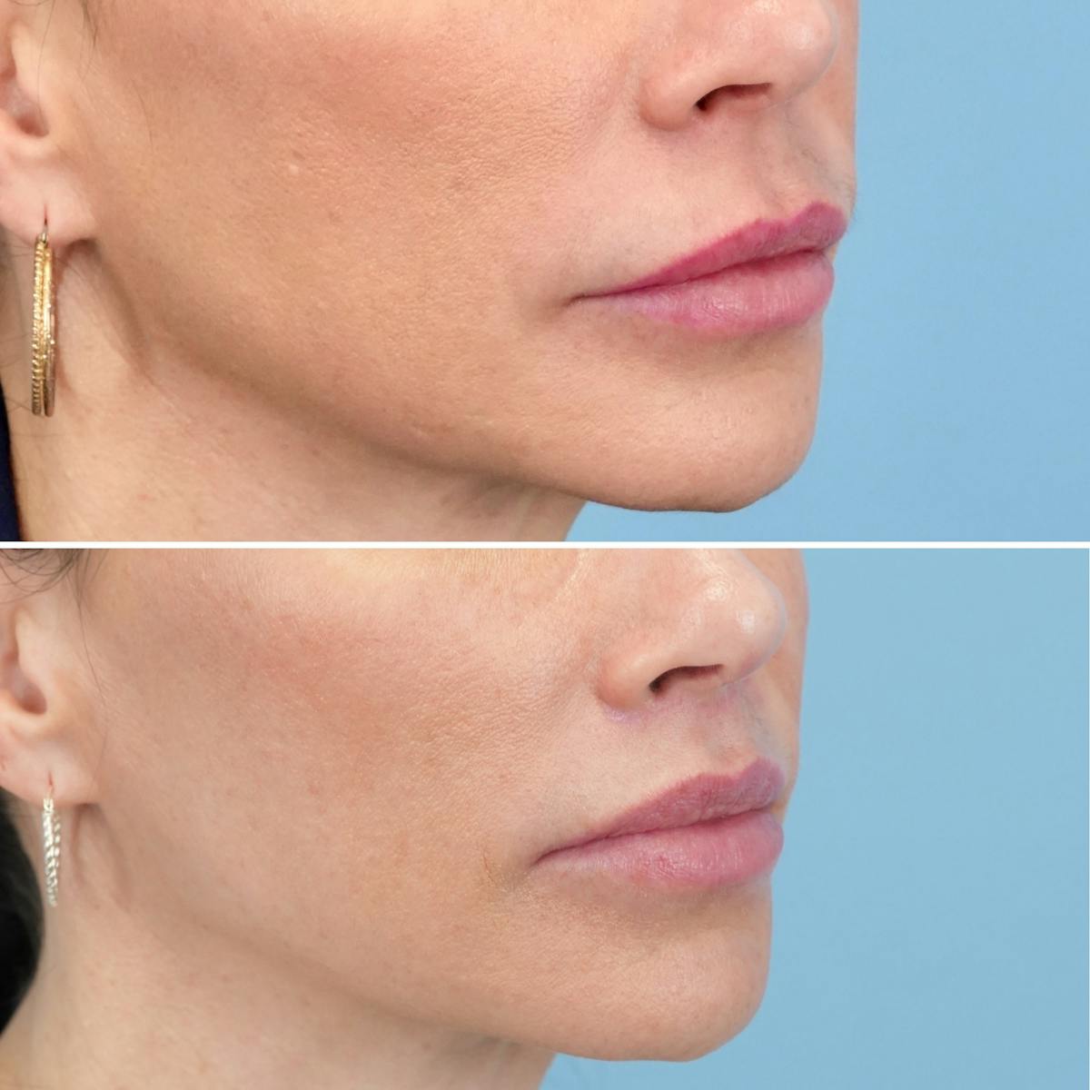Lip Lift Before & After Gallery - Patient 410047 - Image 3