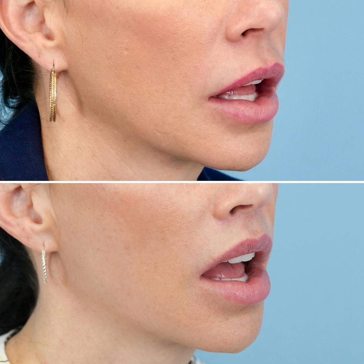 Lip Lift Before & After Gallery - Patient 410047 - Image 4