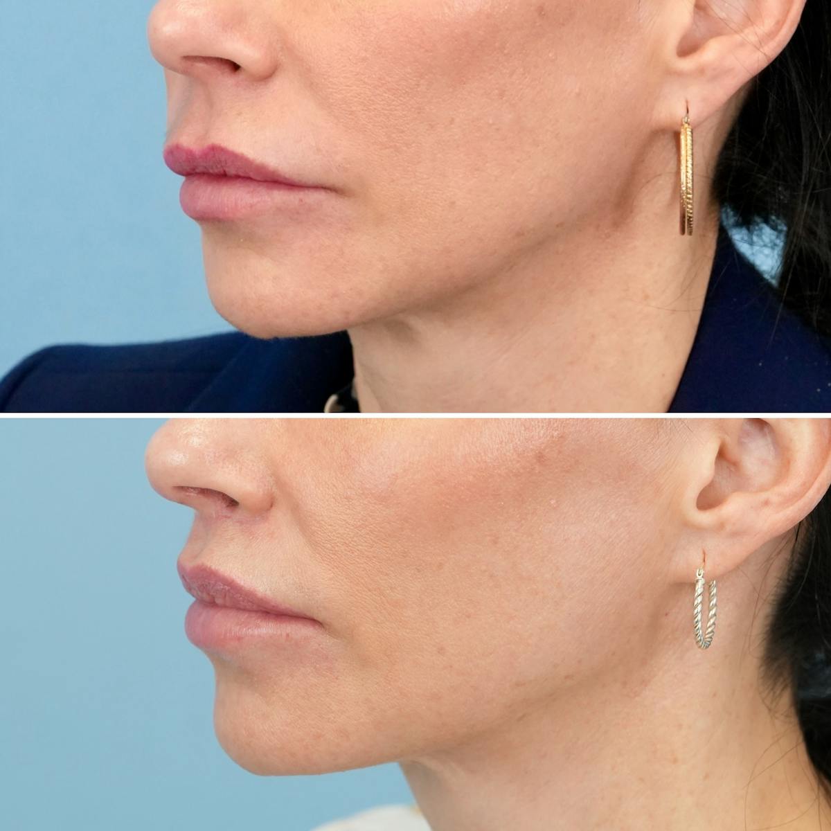 Lip Lift Before & After Gallery - Patient 410047 - Image 5