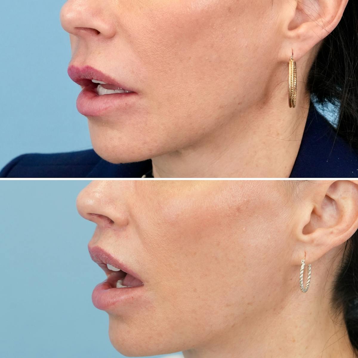 Lip Lift Before & After Gallery - Patient 410047 - Image 6