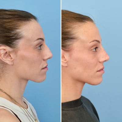 Rhinoplasty Before & After Gallery - Patient 529286 - Image 1
