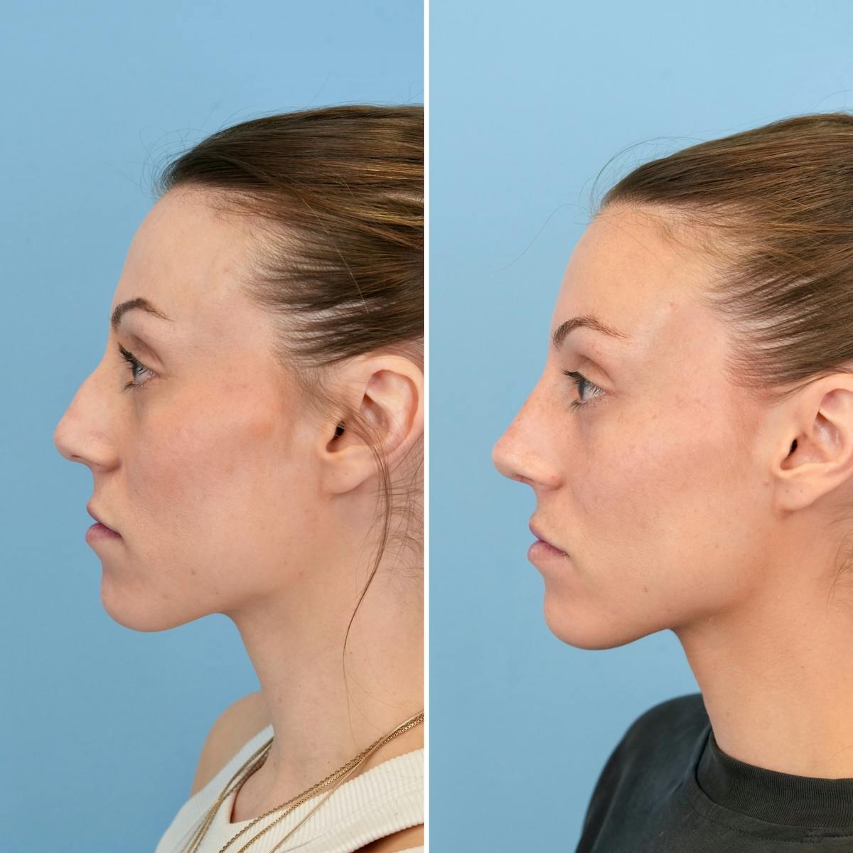 Rhinoplasty Before & After Gallery - Patient 529286 - Image 8
