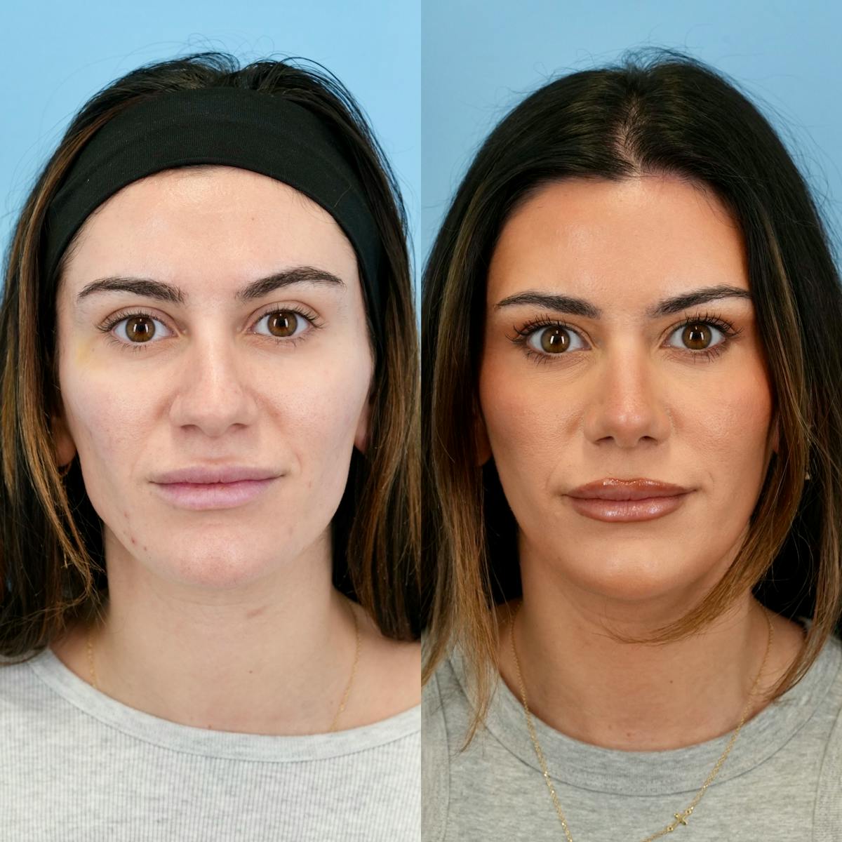 Rhinoplasty Before & After Gallery - Patient 310625 - Image 5