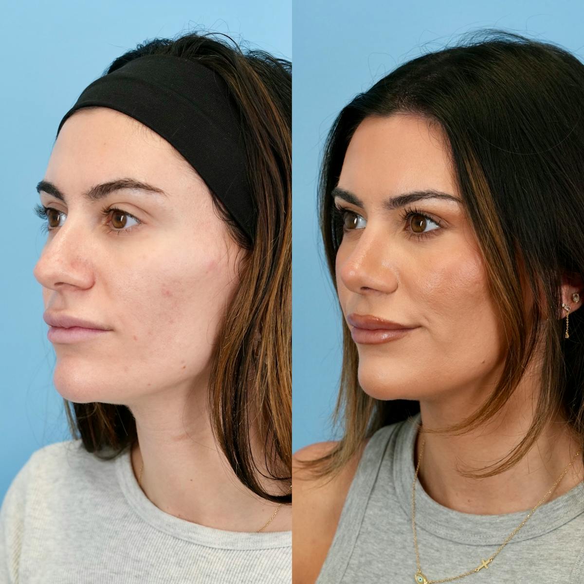 Rhinoplasty Before & After Gallery - Patient 310625 - Image 6