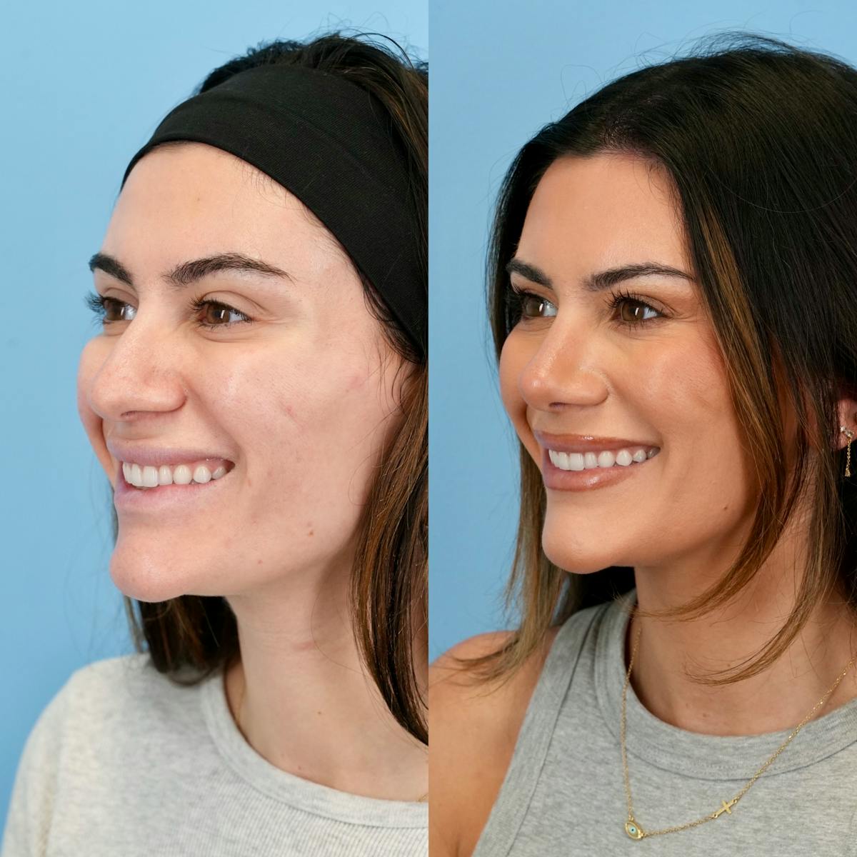 Rhinoplasty Before & After Gallery - Patient 310625 - Image 7