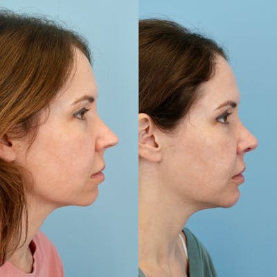 Rhinoplasty Before & After Gallery - Patient 982554 - Image 1