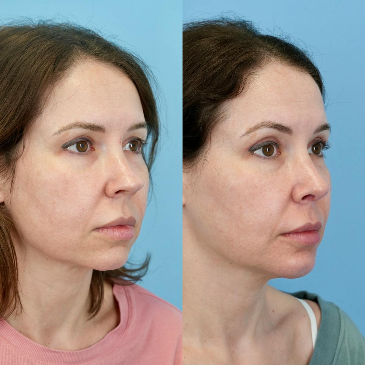 Rhinoplasty Before & After Gallery - Patient 982554 - Image 2