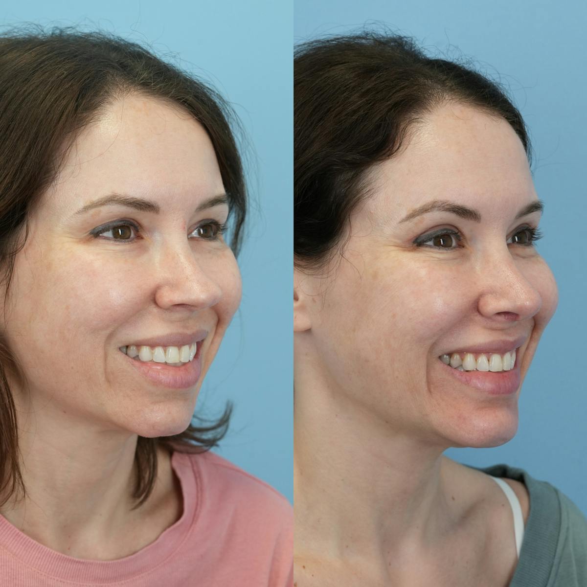 Rhinoplasty Before & After Gallery - Patient 982554 - Image 3